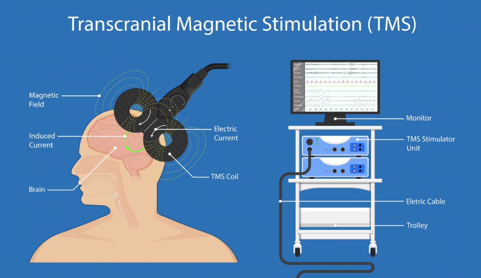 Neuroelectrics raises $17.5m to transform epilepsy treatment | Sifted